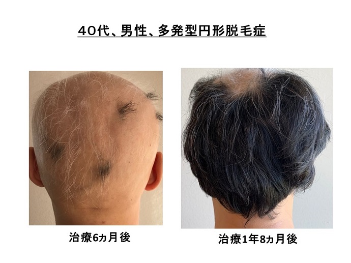 円形脱毛症　病院
